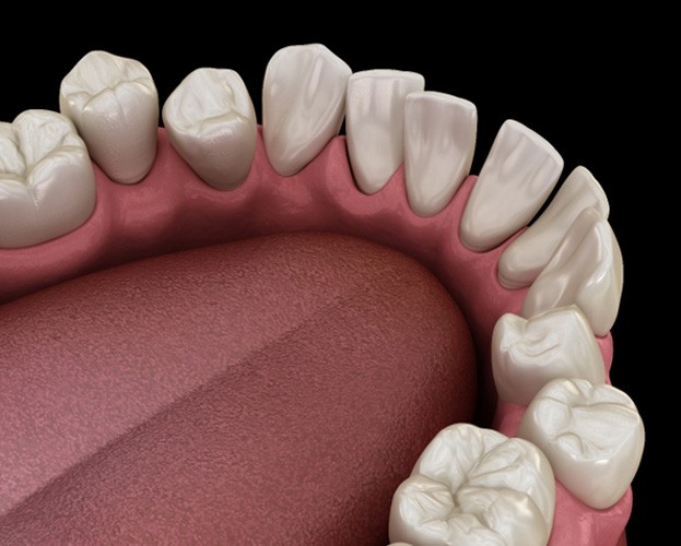 3D illustration of crooked teeth  